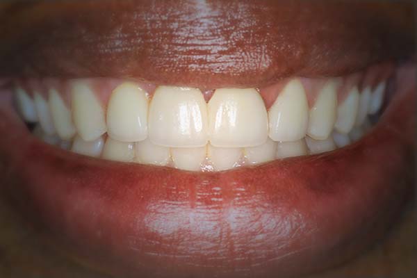 dental crowns photos