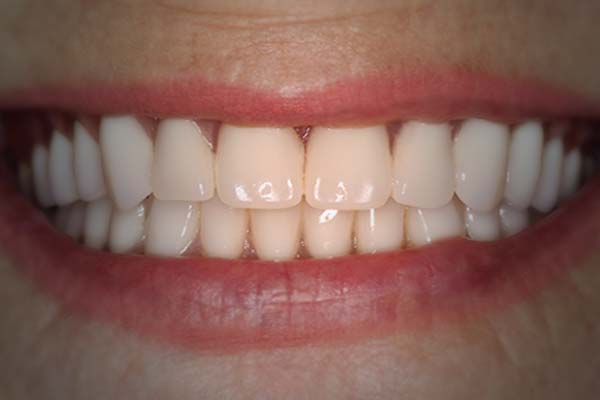 implant denture photos