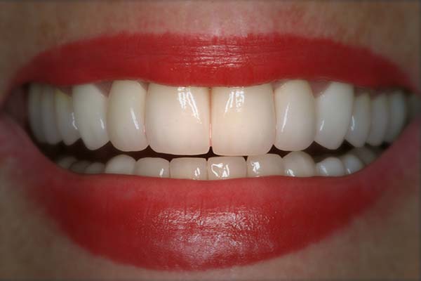dental implant photos