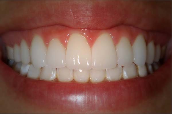 dental veneers photos