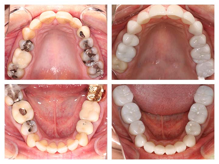 tooth implant before after