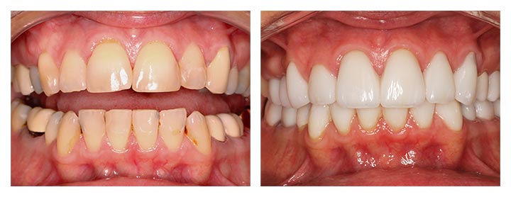 dental implants before and after photos