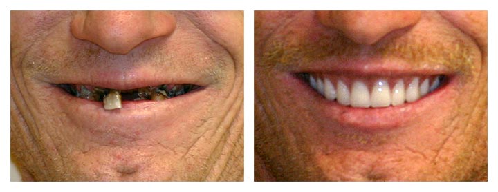 restorative dentistry before and after photos
