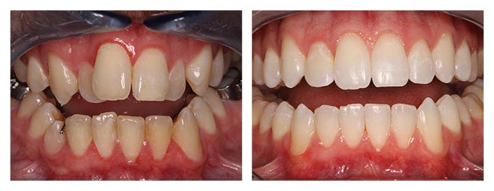 invisalign before and after photos