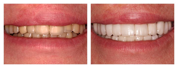dental veneers before and after photos