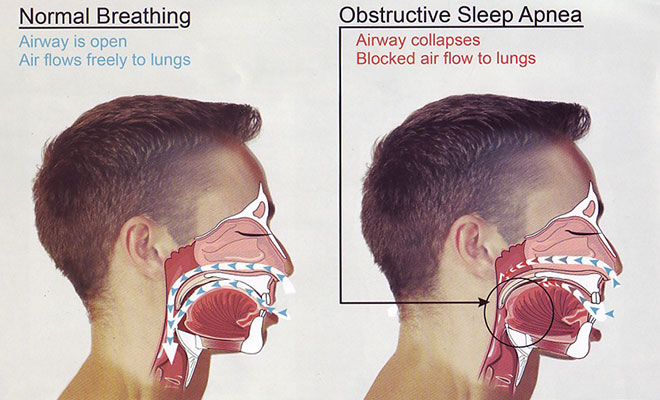sleep apnea airflow diagram