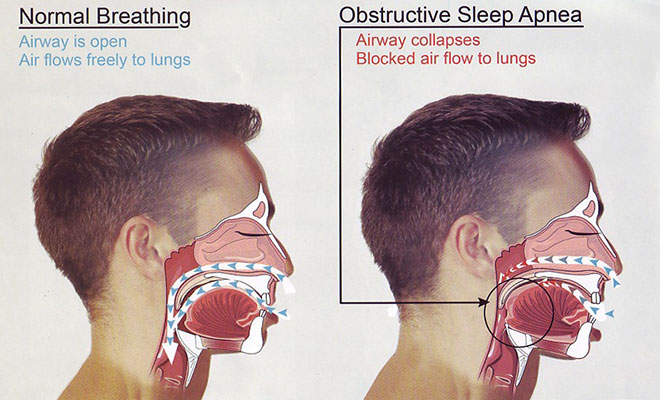 Dental Sleep Medicine - Sleep Apnea | Winterville Dental