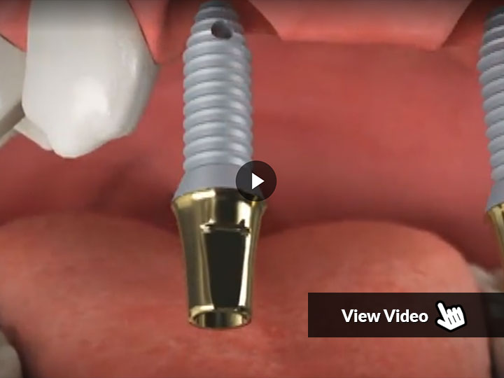 Why Implants for Partially Edentulous Patients?